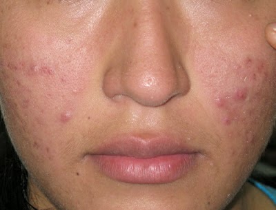 the-emergence-of-acne